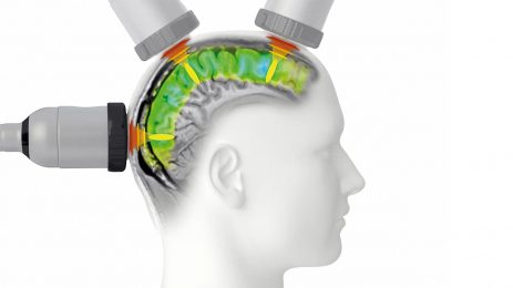 Nöroloji ve psikiyatri alanında beyin stimülasyon tedavileri