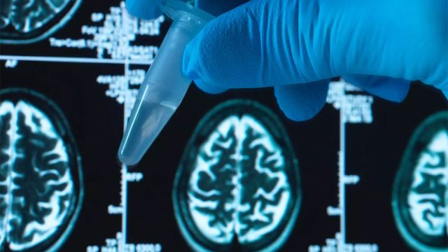 Alzheimer tedavisinde umut veren çalışma