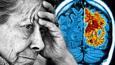 Alzheimer hastalığı neden olur?