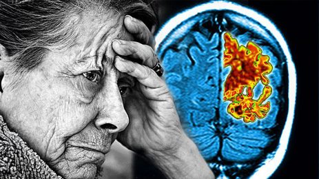 Alzheimer’ı önleyebilecek yeni bir ipucu