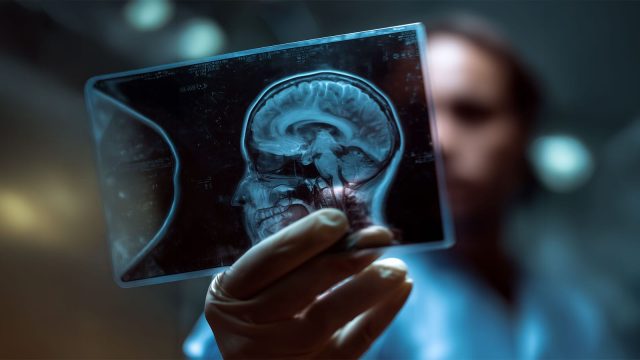 Hipoksik Beyin Hasarında En Çok Hangi Bölgeler Etkilenir?